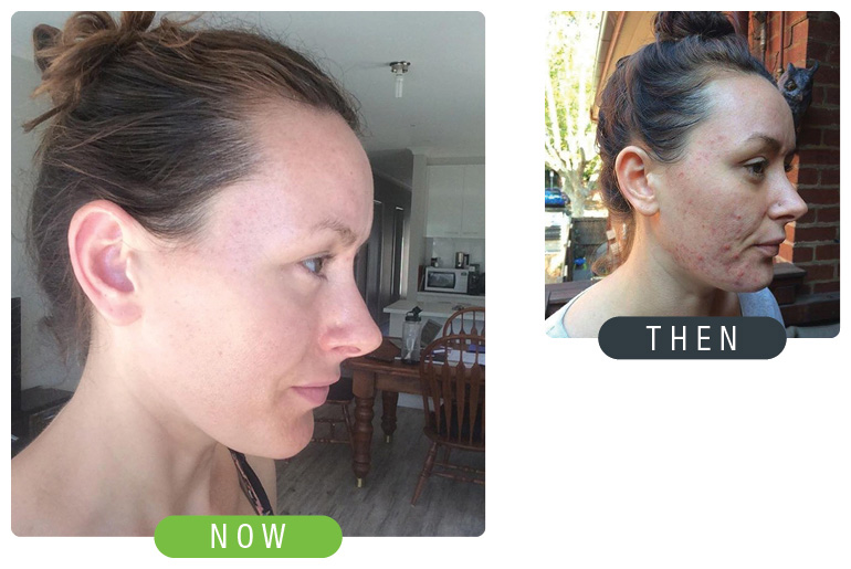Woman Then Now Skin Improvement