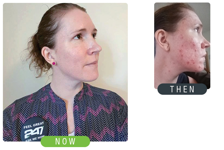 Woman Then Now Skin Improvement